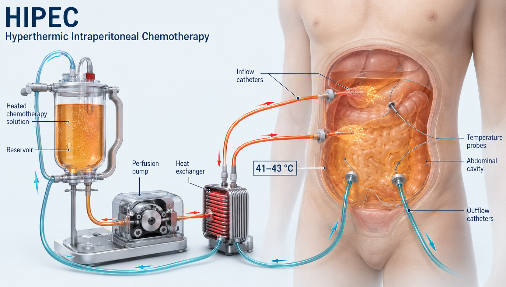 Medical diagram of HIPEC showing heated chemotherapy solution, reservoir, perfusion pump, heat exchanger, inflow and outflow catheters, temperature probes and abdominal circulation at 41 to 43 degrees Celsius