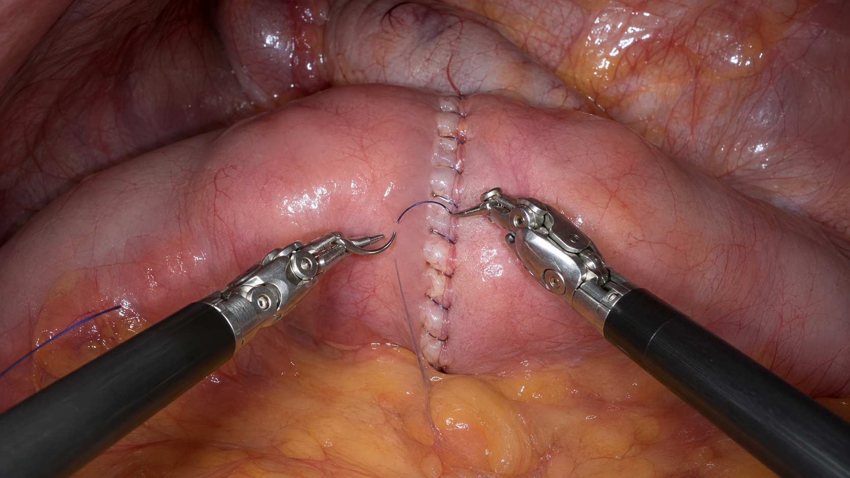 Close-up view of robotic surgical instruments performing precise suturing